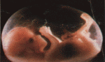 foetus_3mois