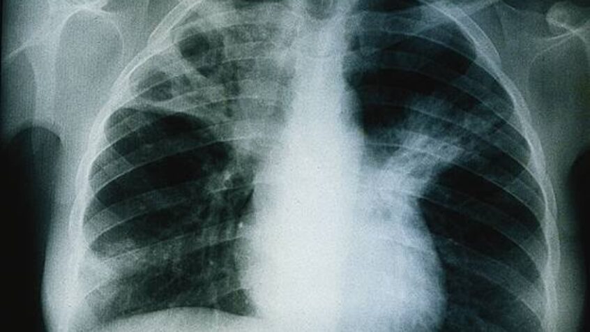 24 mars : journée universelle de la tuberculose